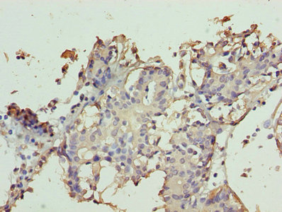 TTC9C Antibody - Immunohistochemistry of paraffin-embedded human breast cancer using TTC9C Antibody at dilution of 1:100