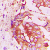TTF / RHOH Antibody - Immunohistochemical analysis of RhoH staining in human lung cancer formalin fixed paraffin embedded tissue section. The section was pre-treated using heat mediated antigen retrieval with sodium citrate buffer (pH 6.0). The section was then incubated with the antibody at room temperature and detected using an HRP conjugated compact polymer system. DAB was used as the chromogen. The section was then counterstained with hematoxylin and mounted with DPX.