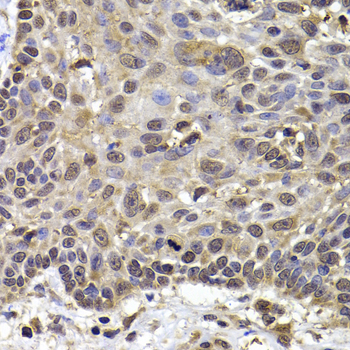 TTF2 / HuF2 Antibody - Immunohistochemistry of paraffin-embedded human well-differentiated squamous skin carcinoma tissue.