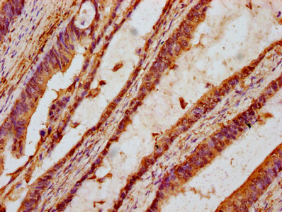 TTI2 / C8orf41 Antibody - Immunohistochemistry Dilution at 1:100 and staining in paraffin-embedded human colon cancer performed on a Leica BondTM system. After dewaxing and hydration, antigen retrieval was mediated by high pressure in a citrate buffer (pH 6.0). Section was blocked with 10% normal Goat serum 30min at RT. Then primary antibody (1% BSA) was incubated at 4°C overnight. The primary is detected by a biotinylated Secondary antibody and visualized using an HRP conjugated SP system.