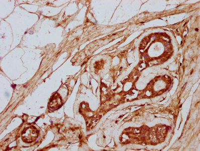 TTLL3 Antibody - Immunohistochemistry Dilution at 1:300 and staining in paraffin-embedded human breast cancer performed on a Leica BondTM system. After dewaxing and hydration, antigen retrieval was mediated by high pressure in a citrate buffer (pH 6.0). Section was blocked with 10% normal Goat serum 30min at RT. Then primary antibody (1% BSA) was incubated at 4°C overnight. The primary is detected by a biotinylated Secondary antibody and visualized using an HRP conjugated SP system.