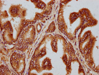 TTLL3 Antibody - Immunohistochemistry Dilution at 1:300 and staining in paraffin-embedded human prostate cancer performed on a Leica BondTM system. After dewaxing and hydration, antigen retrieval was mediated by high pressure in a citrate buffer (pH 6.0). Section was blocked with 10% normal Goat serum 30min at RT. Then primary antibody (1% BSA) was incubated at 4°C overnight. The primary is detected by a biotinylated Secondary antibody and visualized using an HRP conjugated SP system.