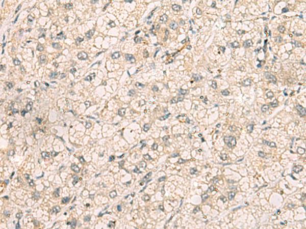 TTLL5 Antibody - Immunohistochemistry of paraffin-embedded Human liver cancer tissue  using TTLL5 Polyclonal Antibody at dilution of 1:70(×200)