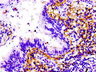TTN / Titin Antibody - IHC image of TTN Antibody diluted at 1:100 and staining in paraffin-embedded human lung cancer performed on a Leica BondTM system. After dewaxing and hydration, antigen retrieval was mediated by high pressure in a citrate buffer (pH 6.0). Section was blocked with 10% normal goat serum 30min at RT. Then primary antibody (1% BSA) was incubated at 4°C overnight. The primary is detected by a biotinylated secondary antibody and visualized using an HRP conjugated SP system.