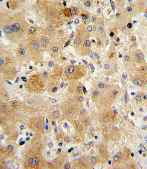 TTR / Transthyretin Antibody - Formalin-fixed and paraffin-embedded human hepatocarcinoma with TTR Antibody , which was peroxidase-conjugated to the secondary antibody, followed by DAB staining. This data demonstrates the use of this antibody for immunohistochemistry; clinical relevance has not been evaluated.