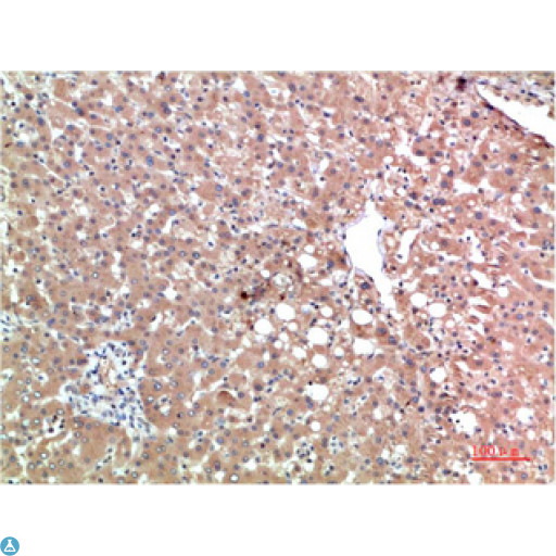 TTR / Transthyretin Antibody - Immunohistochemical analysis of paraffin-embedded Human Liver Carcinoma Tissue using TTR Mouse mAb diluted at 1:200.