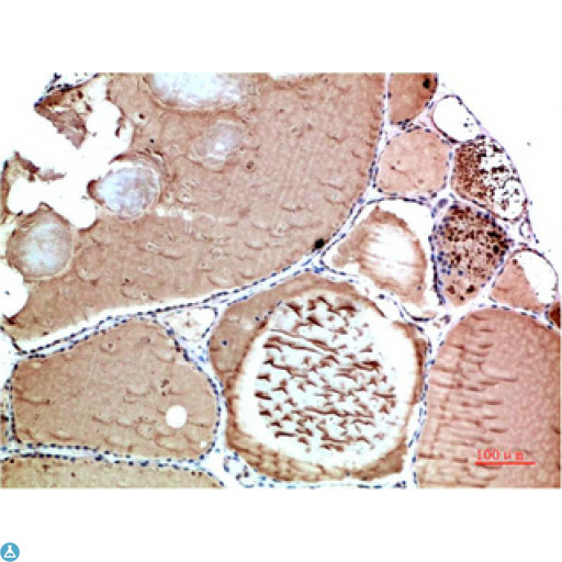 TTR / Transthyretin Antibody - Immunohistochemical analysis of paraffin-embedded Human Thyroid Tissue using TTR Mouse mAb diluted at 1:200.