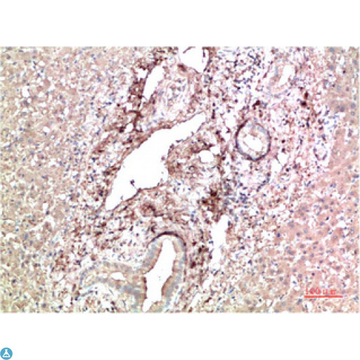 TTR / Transthyretin Antibody - Immunohistochemical analysis of paraffin-embedded Human Liver Carcinoma Tissue using TTR Mouse mAb diluted at 1:200.