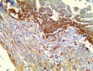 TTR / Transthyretin Antibody - IHC of Prealbumin / Transthyretin on an FFPE Hepatocellular Carcinoma Tissue