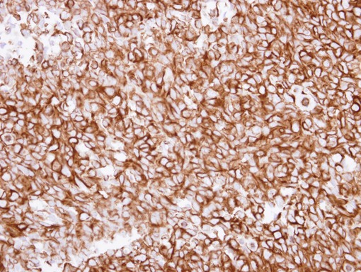 TUBA1A / Tubulin Alpha 1a Antibody - IHC of paraffin-embedded Breast ca using alpha Tubulin 1A antibody at 1:250 dilution.