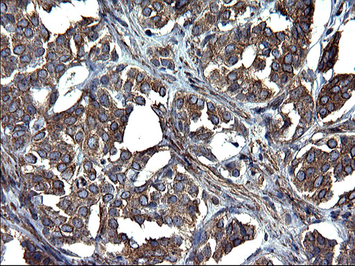 TUBA1A / Tubulin Alpha 1a Antibody - IHC of paraffin-embedded Adenocarcinoma of Human breast tissue using anti-TUBA1A mouse monoclonal antibody. (Heat-induced epitope retrieval by 1 mM EDTA in 10mM Tris, pH8.5, 120°C for 3min).