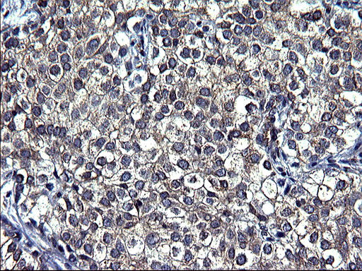 TUBA1A / Tubulin Alpha 1a Antibody - IHC of paraffin-embedded Carcinoma of Human liver tissue using anti-TUBA1A mouse monoclonal antibody. (Heat-induced epitope retrieval by 1 mM EDTA in 10mM Tris, pH8.5, 120°C for 3min).