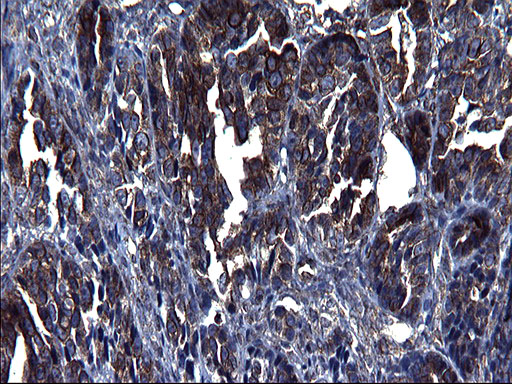 TUBA1A / Tubulin Alpha 1a Antibody - IHC of paraffin-embedded Adenocarcinoma of Human ovary tissue using anti-TUBA1A mouse monoclonal antibody. (Heat-induced epitope retrieval by 1 mM EDTA in 10mM Tris, pH8.5, 120°C for 3min).