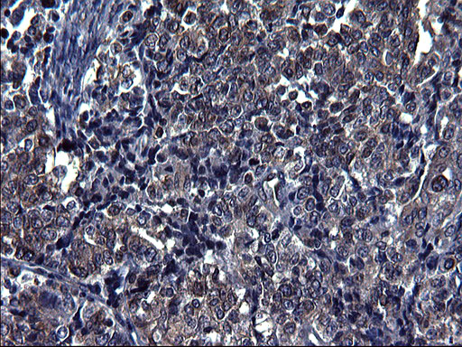 TUBA1A / Tubulin Alpha 1a Antibody - IHC of paraffin-embedded Adenocarcinoma of Human endometrium tissue using anti-TUBA1A mouse monoclonal antibody. (Heat-induced epitope retrieval by 1 mM EDTA in 10mM Tris, pH8.5, 120°C for 3min).