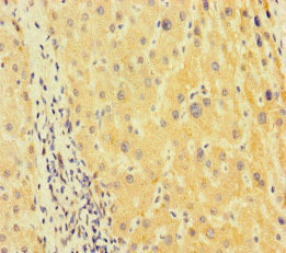 TUBA1B / Tubulin Alpha 1B Antibody - Immunohistochemistry of paraffin-embedded human liver cancer at dilution of 1:100