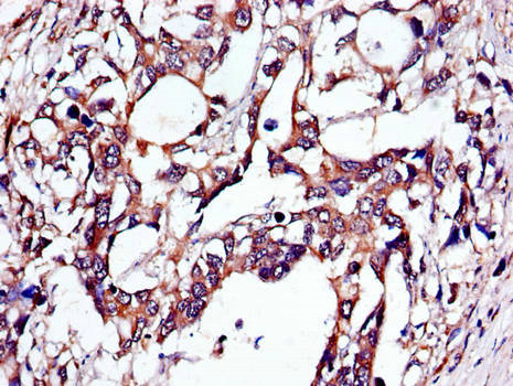 TUBA4A / TUBA1 Antibody - Immunohistochemistry of paraffin-embedded human gastric cancer using TUBA4A Antibody at dilution of 1:100