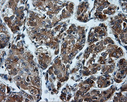 TUBA8 / Tubulin Alpha 8 Antibody - IHC of paraffin-embedded Carcinoma of liver tissue using anti- mouse monoclonal antibody. (Dilution 1:50).