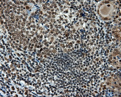 TUBA8 / Tubulin Alpha 8 Antibody - IHC of paraffin-embedded Carcinoma of thyroid tissue using anti- mouse monoclonal antibody. (Dilution 1:50).