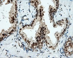 TUBA8 / Tubulin Alpha 8 Antibody - IHC of paraffin-embedded Carcinoma of prostate tissue using anti- mouse monoclonal antibody. (Dilution 1:50).