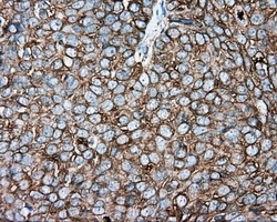 TUBA8 / Tubulin Alpha 8 Antibody - Immunohistochemical staining of paraffin-embedded Adenocarcinoma of ovary tissue using anti-TUBA8 mouse monoclonal antibody. (Dilution 1:50).