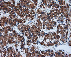 TUBA8 / Tubulin Alpha 8 Antibody - IHC of paraffin-embedded Carcinoma of liver tissue using anti-TUBA8 mouse monoclonal antibody. (Dilution 1:50).