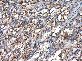 TUBAL3 Antibody - IHC of paraffin-embedded Carcinoma of Human kidney tissue using anti-TUBAL3 mouse monoclonal antibody.