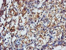 TUBAL3 Antibody - IHC of paraffin-embedded Carcinoma of Human kidney tissue using anti-TUBAL3 mouse monoclonal antibody.