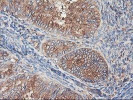 TUBAL3 Antibody - IHC of paraffin-embedded Adenocarcinoma of Human endometrium tissue using anti-TUBAL3 mouse monoclonal antibody.