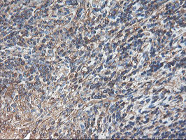 TUBAL3 Antibody - IHC of paraffin-embedded Human lymphoma tissue using anti-TUBAL3 mouse monoclonal antibody.
