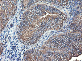 TUBAL3 Antibody - IHC of paraffin-embedded Adenocarcinoma of Human endometrium tissue using anti-TUBAL3 mouse monoclonal antibody.