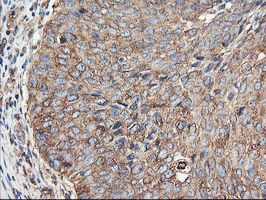 TUBAL3 Antibody - IHC of paraffin-embedded Carcinoma of Human bladder tissue using anti-TUBAL3 mouse monoclonal antibody.