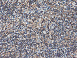 TUBAL3 Antibody - IHC of paraffin-embedded Human lymphoma tissue using anti-TUBAL3 mouse monoclonal antibody.