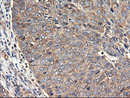 TUBAL3 Antibody - IHC of paraffin-embedded Carcinoma of Human bladder tissue using anti-TUBAL3 mouse monoclonal antibody.