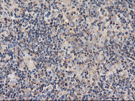 TUBAL3 Antibody - IHC of paraffin-embedded Human lymphoma tissue using anti-TUBAL3 mouse monoclonal antibody.
