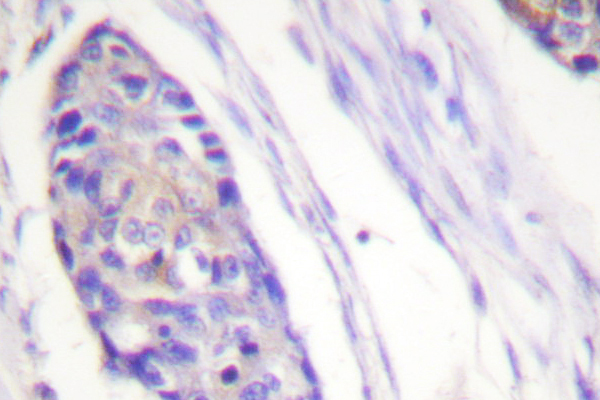 TUBB / Beta Tubulin Antibody - IHC of Tubulin (G434) pAb in paraffin-embedded human breast carcinoma tissue.