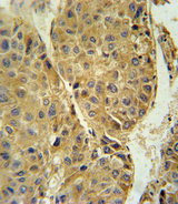TUBB3 / Tubulin Beta 3 Antibody - TUBB3 Antibody immunohistochemistry of formalin-fixed and paraffin-embedded human hepatocarcinoma followed by peroxidase-conjugated secondary antibody and DAB staining.