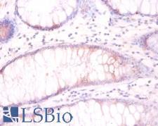 TUBB3 / Tubulin Beta 3 Antibody - Immunohistochemistry of paraffin-embedded colorectal carcinoma using TUBB3 / Tubulin Beta 3 antibody at dilution of 1:50.  This image was taken for the unconjugated form of this product. Other forms have not been tested.