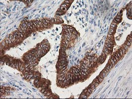 TUBB4 / Tubulin Beta 4 Antibody - IHC of paraffin-embedded Adenocarcinoma of Human colon tissue using anti-TUBB4 mouse monoclonal antibody.