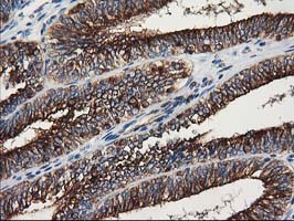 TUBB4 / Tubulin Beta 4 Antibody - IHC of paraffin-embedded Adenocarcinoma of Human endometrium tissue using anti-TUBB4 mouse monoclonal antibody.