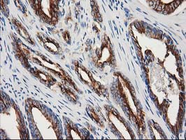 TUBB4 / Tubulin Beta 4 Antibody - IHC of paraffin-embedded Carcinoma of Human prostate tissue using anti-TUBB4 mouse monoclonal antibody.