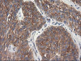 TUBB4 / Tubulin Beta 4 Antibody - IHC of paraffin-embedded Carcinoma of Human bladder tissue using anti-TUBB4 mouse monoclonal antibody.