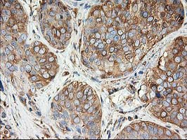 TUBB4 / Tubulin Beta 4 Antibody - IHC of paraffin-embedded Adenocarcinoma of Human breast tissue using anti-TUBB4 mouse monoclonal antibody.
