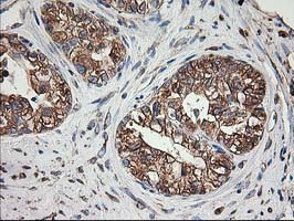 TUBB4 / Tubulin Beta 4 Antibody - IHC of paraffin-embedded Adenocarcinoma of Human ovary tissue using anti-TUBB4 mouse monoclonal antibody.