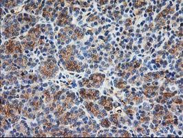 TUBB4 / Tubulin Beta 4 Antibody - IHC of paraffin-embedded Carcinoma of Human thyroid tissue using anti-TUBB4 mouse monoclonal antibody.