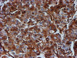 TUBB4 / Tubulin Beta 4 Antibody - IHC of paraffin-embedded Carcinoma of Human liver tissue using anti-TUBB4 mouse monoclonal antibody.