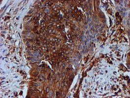 TUBB4 / Tubulin Beta 4 Antibody - IHC of paraffin-embedded Carcinoma of Human bladder tissue using anti-TUBB4 mouse monoclonal antibody.