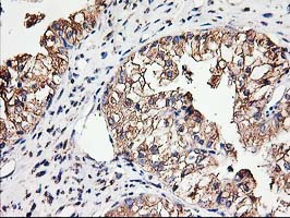 TUBB4 / Tubulin Beta 4 Antibody - IHC of paraffin-embedded Adenocarcinoma of Human ovary tissue using anti-TUBB4 mouse monoclonal antibody.