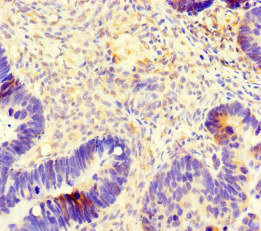 TUBB4 / Tubulin Beta 4 Antibody - Immunohistochemistry of paraffin-embedded human ovarian cancer at dilution of 1:100