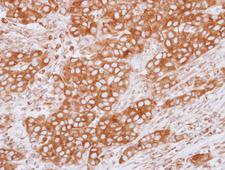 TUBB4B / Tubulin Beta 4B Antibody - IHC of paraffin-embedded Breast ca, using beta Tubulin 2C antibody at 1:500 dilution.
