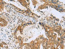 TUBD1 / Tubulin Delta Antibody - Immunohistochemistry of paraffin-embedded Human cervical cancer tissue  using TUBD1 Polyclonal Antibody at dilution of 1:70(×200)